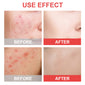 True Hydrocolloid Invisible Essential Oil Acne Patch